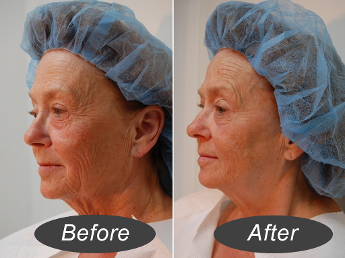before and after
