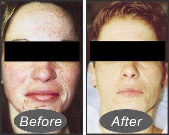 microderm facial