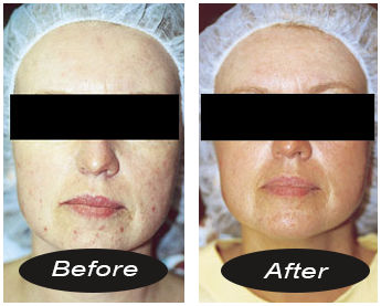 oxy mist facial